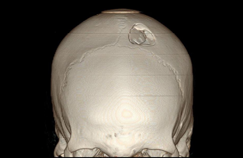 Перелом костей черепа фото
