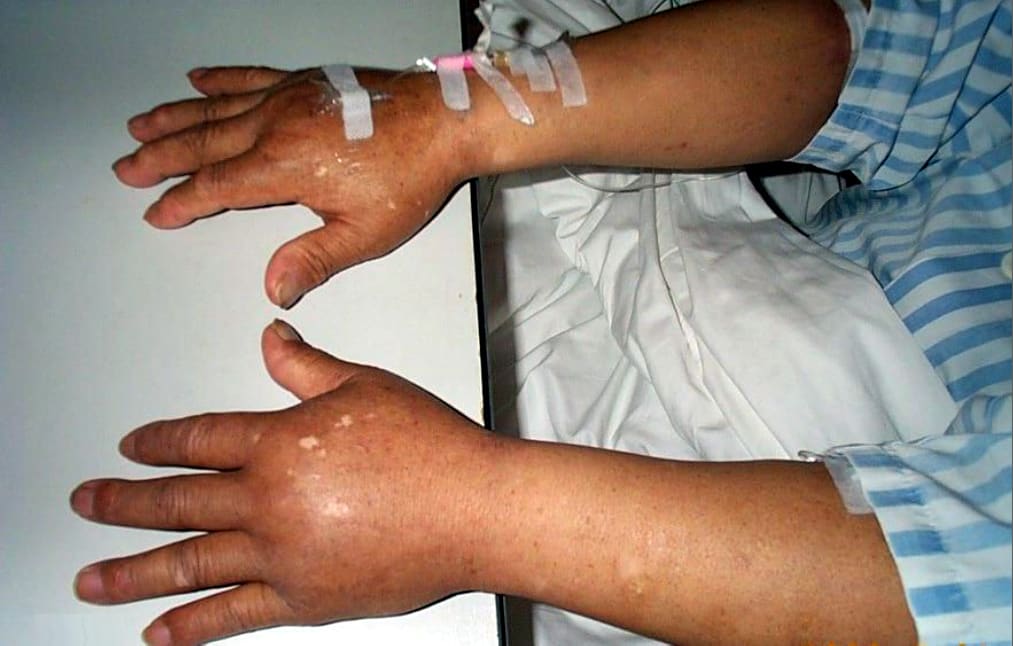 Edema Hands 01
