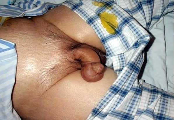 Penile Edema 01