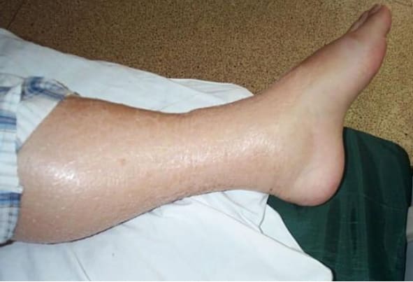 Leg Edema 01