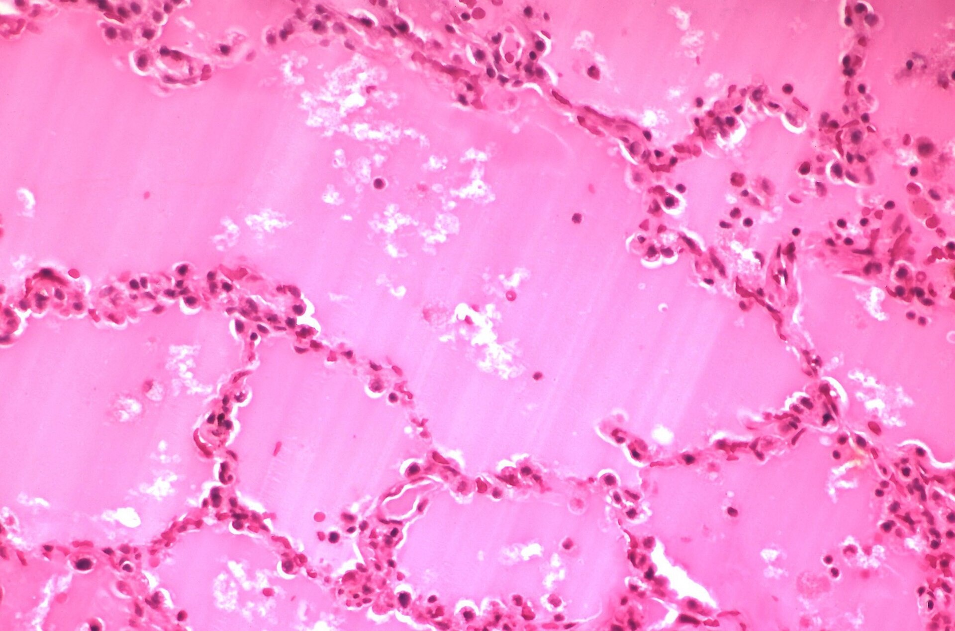 Pulmonary edema