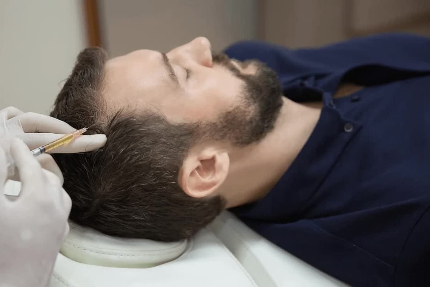 PRP Hair Restoration in Encinitas | Non-Surgical Hair Loss Treatment