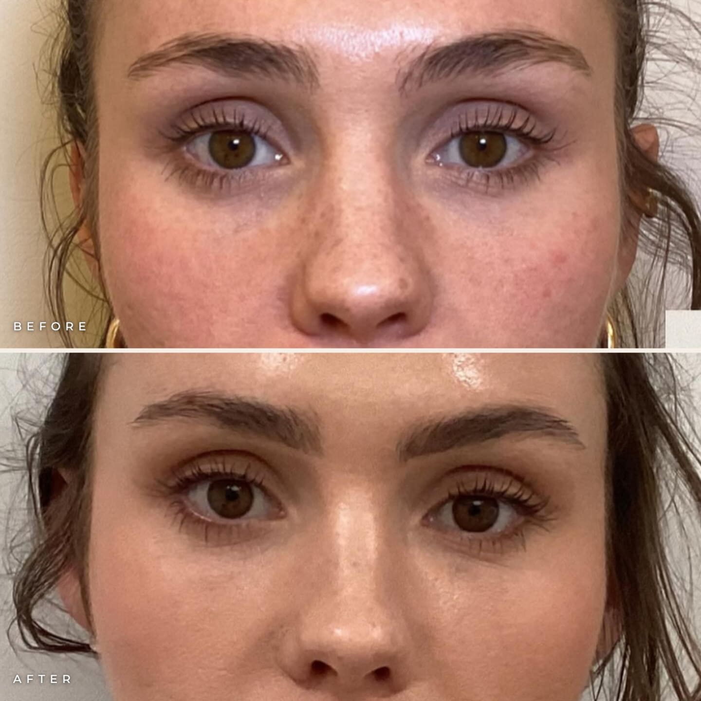 BioRePeel and Jeuveau before and after at Call of Beauty Med Spa, Encinitas: face before treatment (top) and brighter, more even skin two weeks later (bottom)