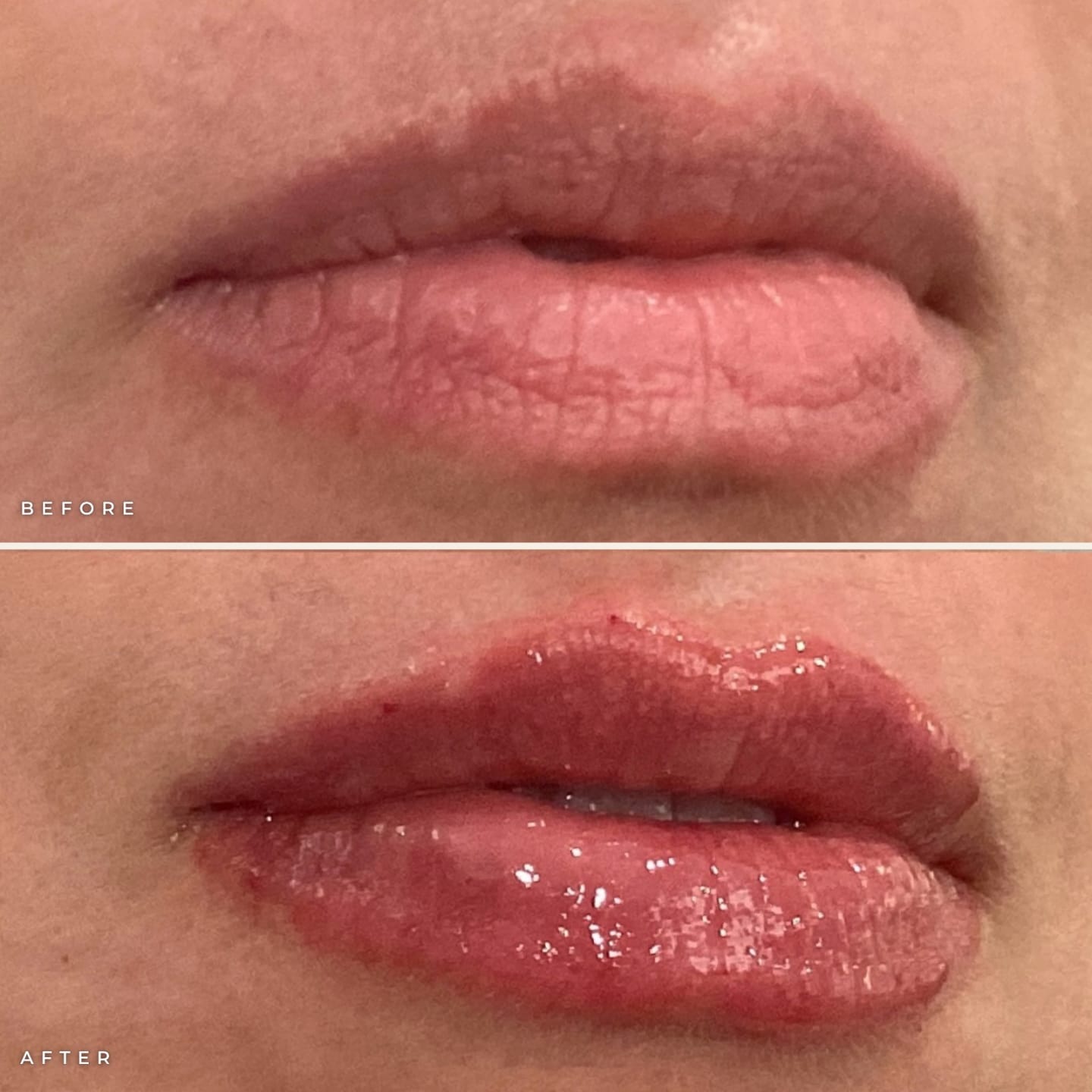 Juvederm Ultra lip filler before and after: dry, thinner lips before (top) and hydrated, plumper lips after (bottom)