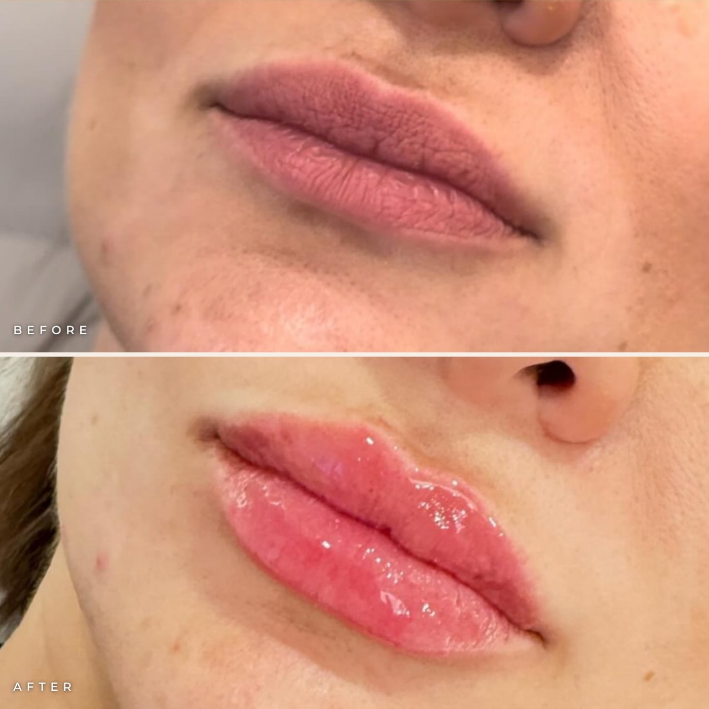 Lip asymmetry correction before and after: uneven lips before treatment (top) and more balanced, fuller lips after filler (bottom)