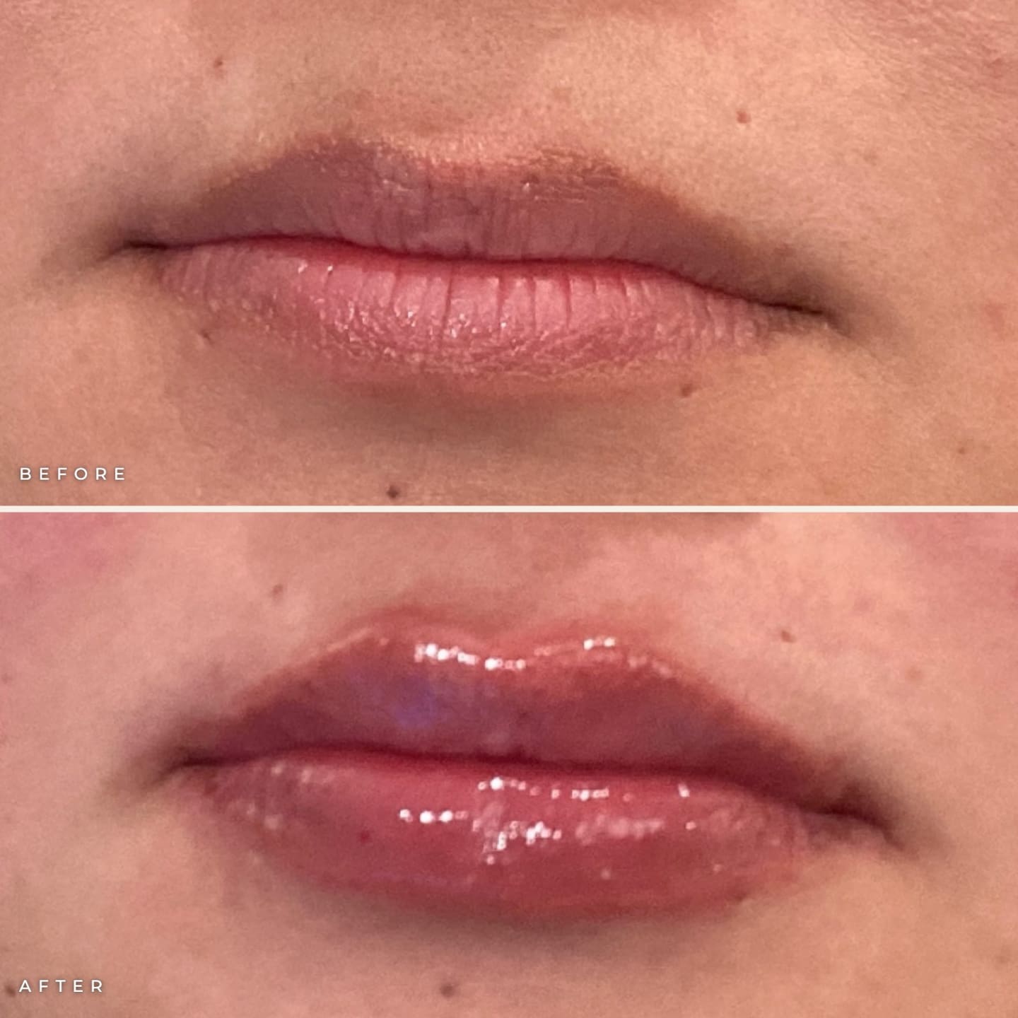 San Diego lip filler before and after: lips before (top) and hydrated, supported lips after Juvederm Ultra XC (bottom) at Call of Beauty Med Spa