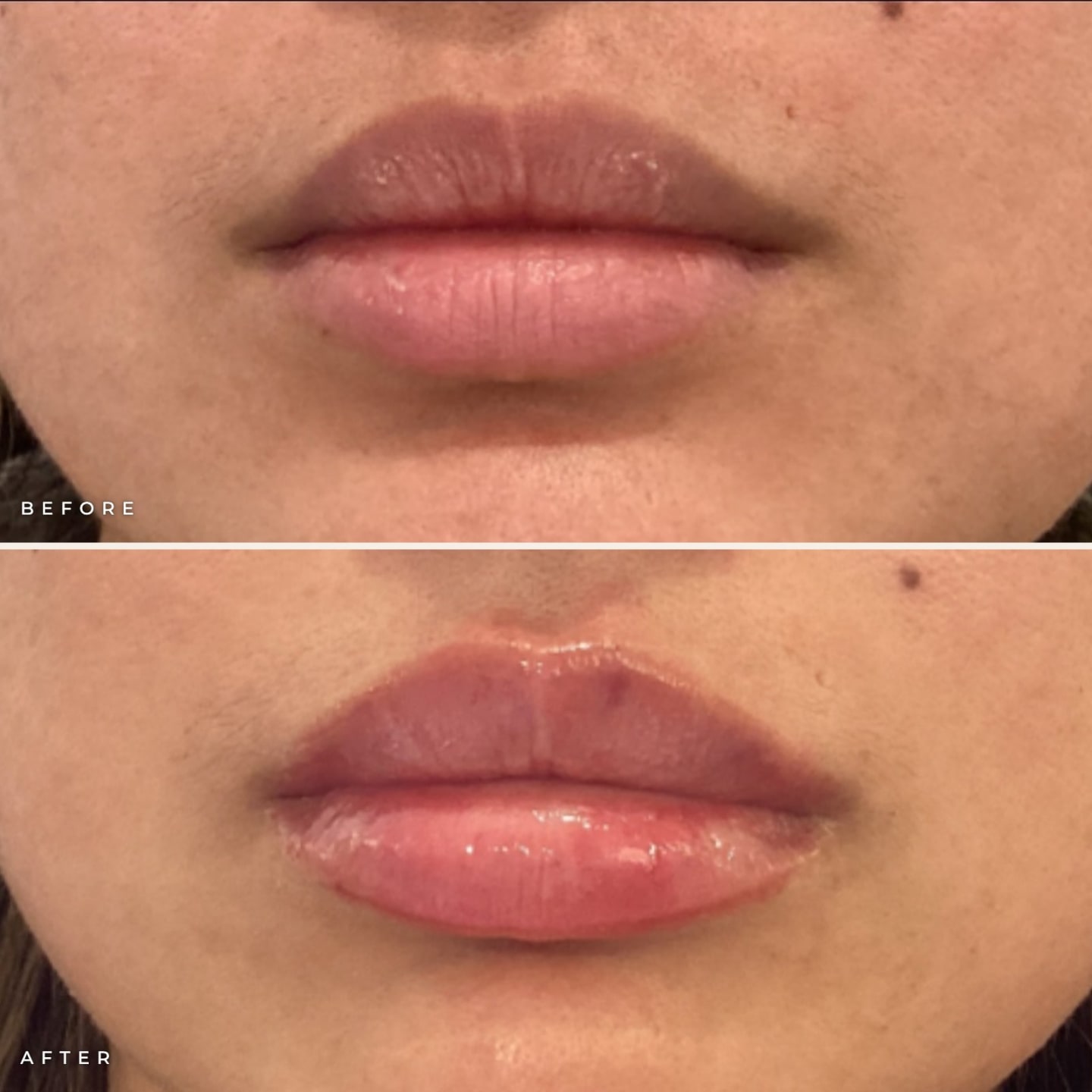 Subtle lip filler before and after for San Diego patients: natural lips before (top) and gently enhanced shape and volume after (bottom)