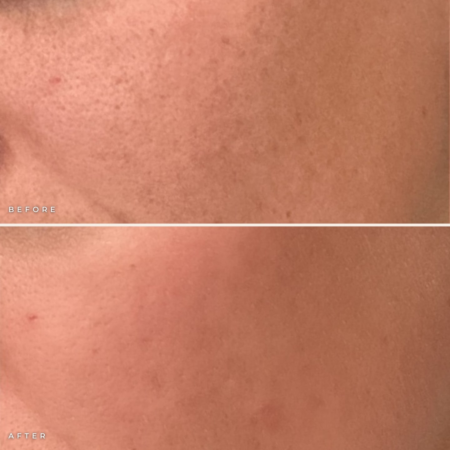 Microneedling with exosomes before and after at Call of Beauty Med Spa, Encinitas: cheek texture before (top) and smoother skin after (bottom)