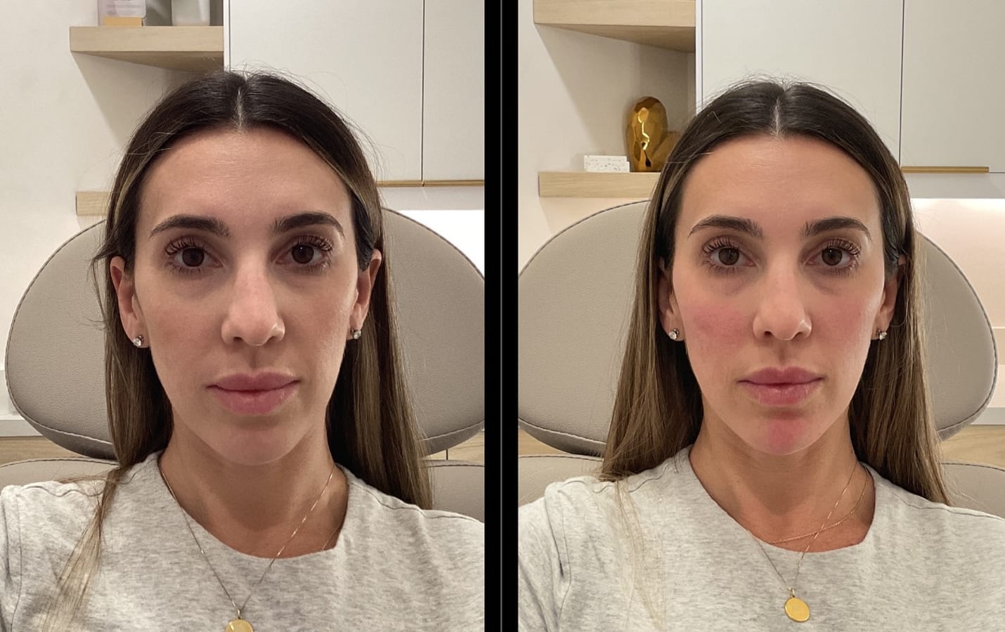 Sculptra before and after, front view showing restored mid-face volume and balanced facial structure, San Diego patient at Call of Beauty Med Spa