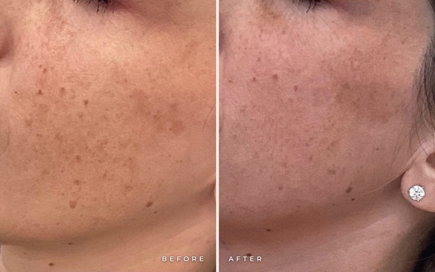 LaseMD and microneedling pigment treatment before and after, left side of the face: pigment before (left) and after the treatment series (right)