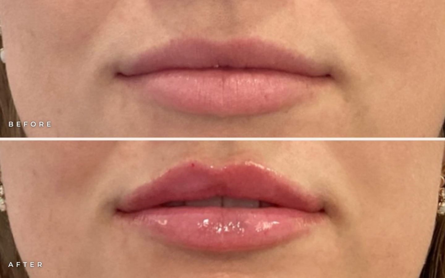 Lip filler before and after at Call of Beauty Med Spa, Encinitas, near Carlsbad: lips before (top) and subtly refined volume and shape after (bottom)