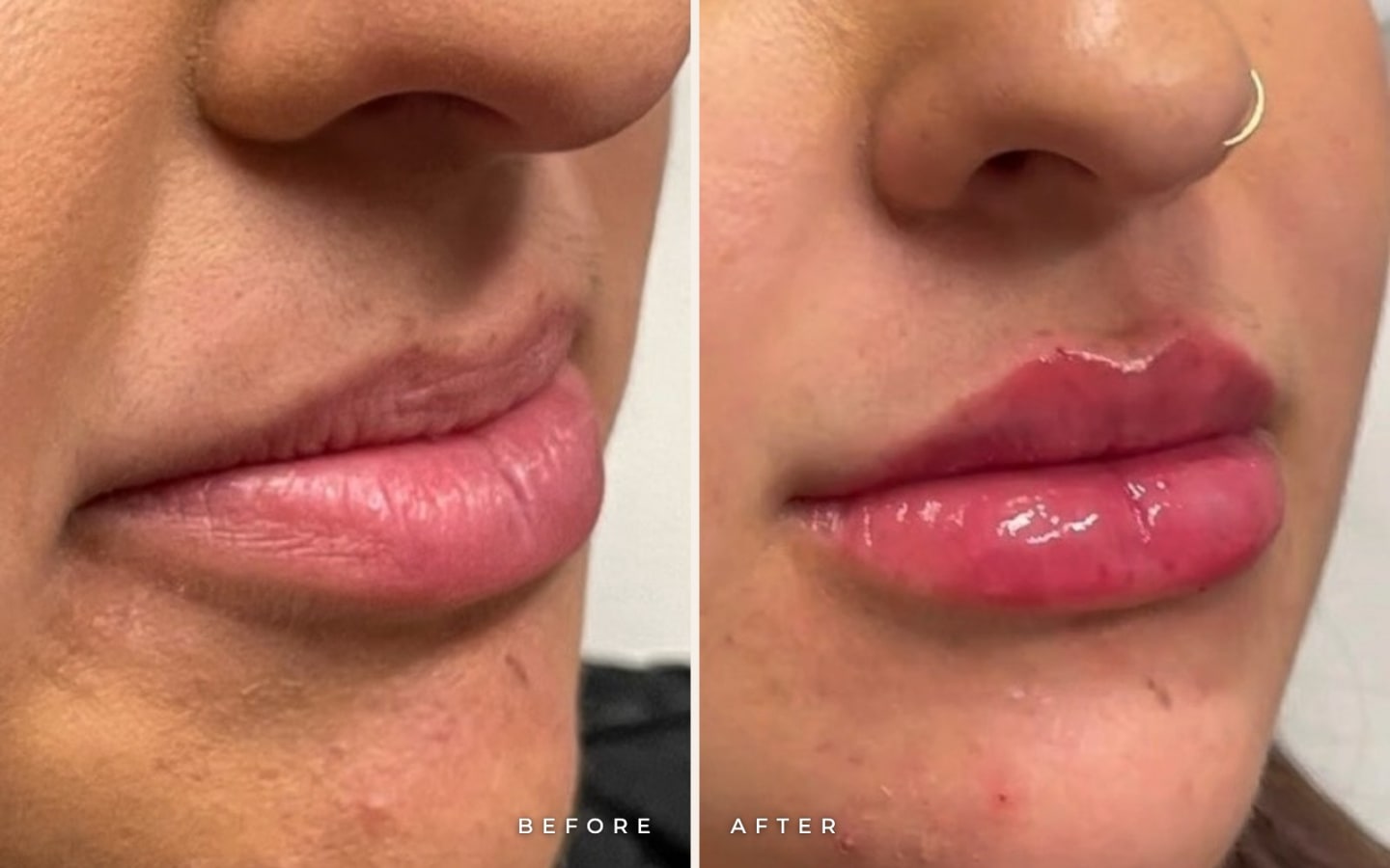 Lip filler before and after for Del Mar patients at Call of Beauty Med Spa in Encinitas: side view of lips before (left) and with a more defined border after (right)