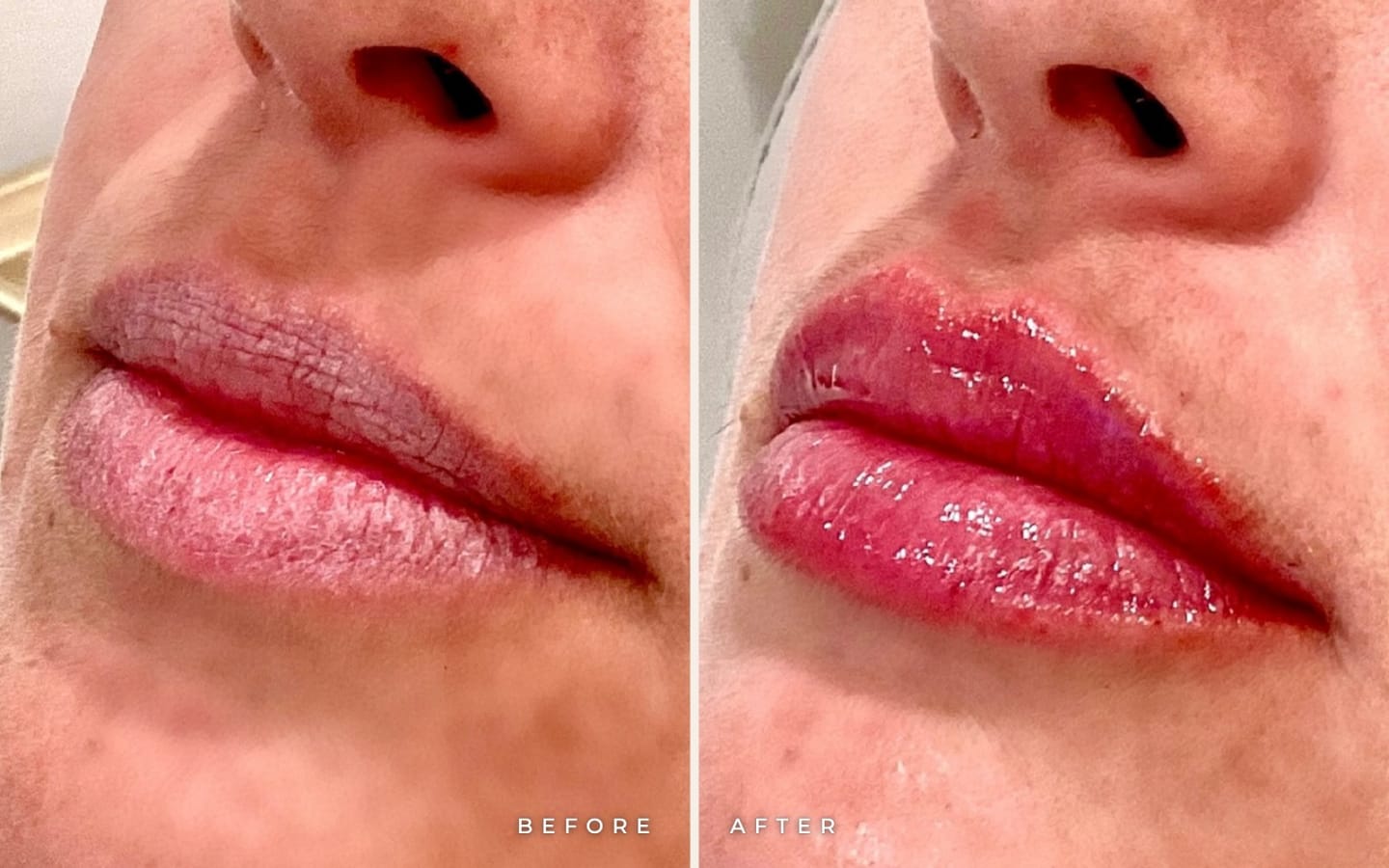 Juvederm Ultra lip filler before and after for Solana Beach patients: lips before (left) and hydrated, fuller lips after (right) at Call of Beauty Med Spa, Encinitas
