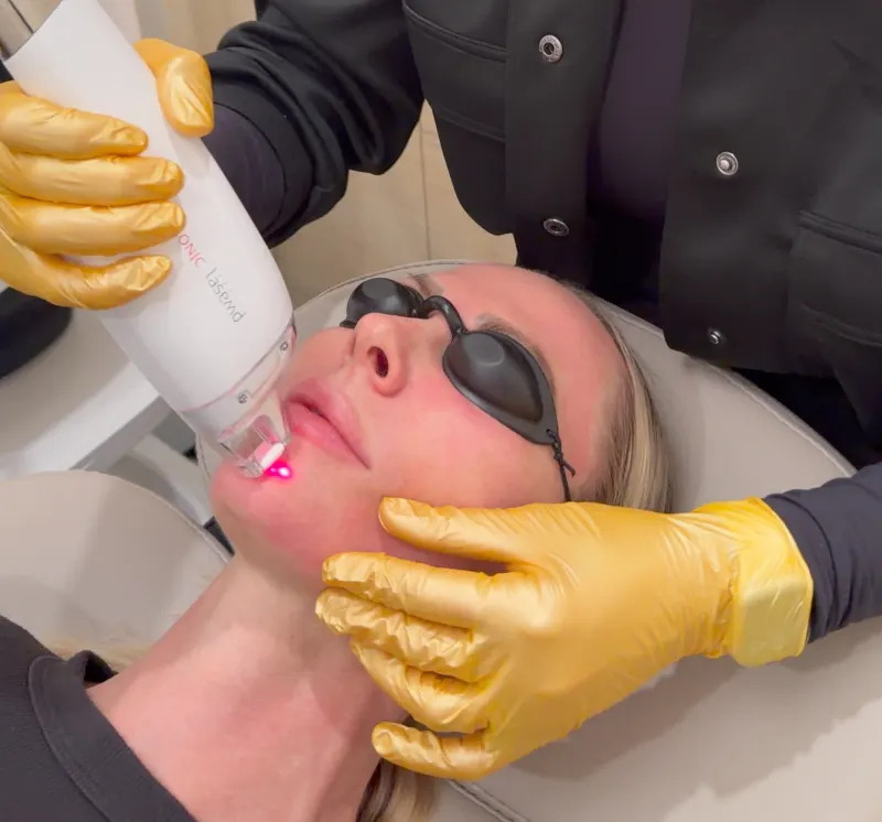 LaseMD Ultra results at Call of Beauty MedSpa Encinitas