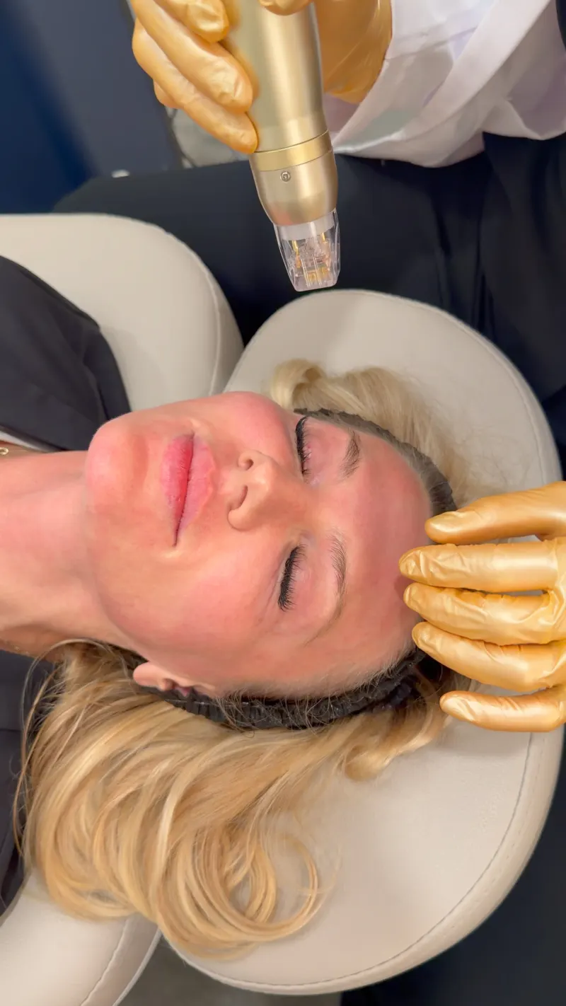 Sylfirm X RF Microneedling treatment at Call of Beauty Med Spa