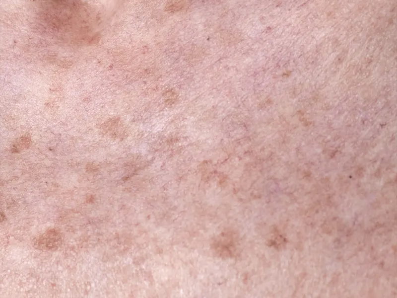 Close-up of sun-damaged chest skin with brown sun spots and fine red capillaries, the pattern IPL treats