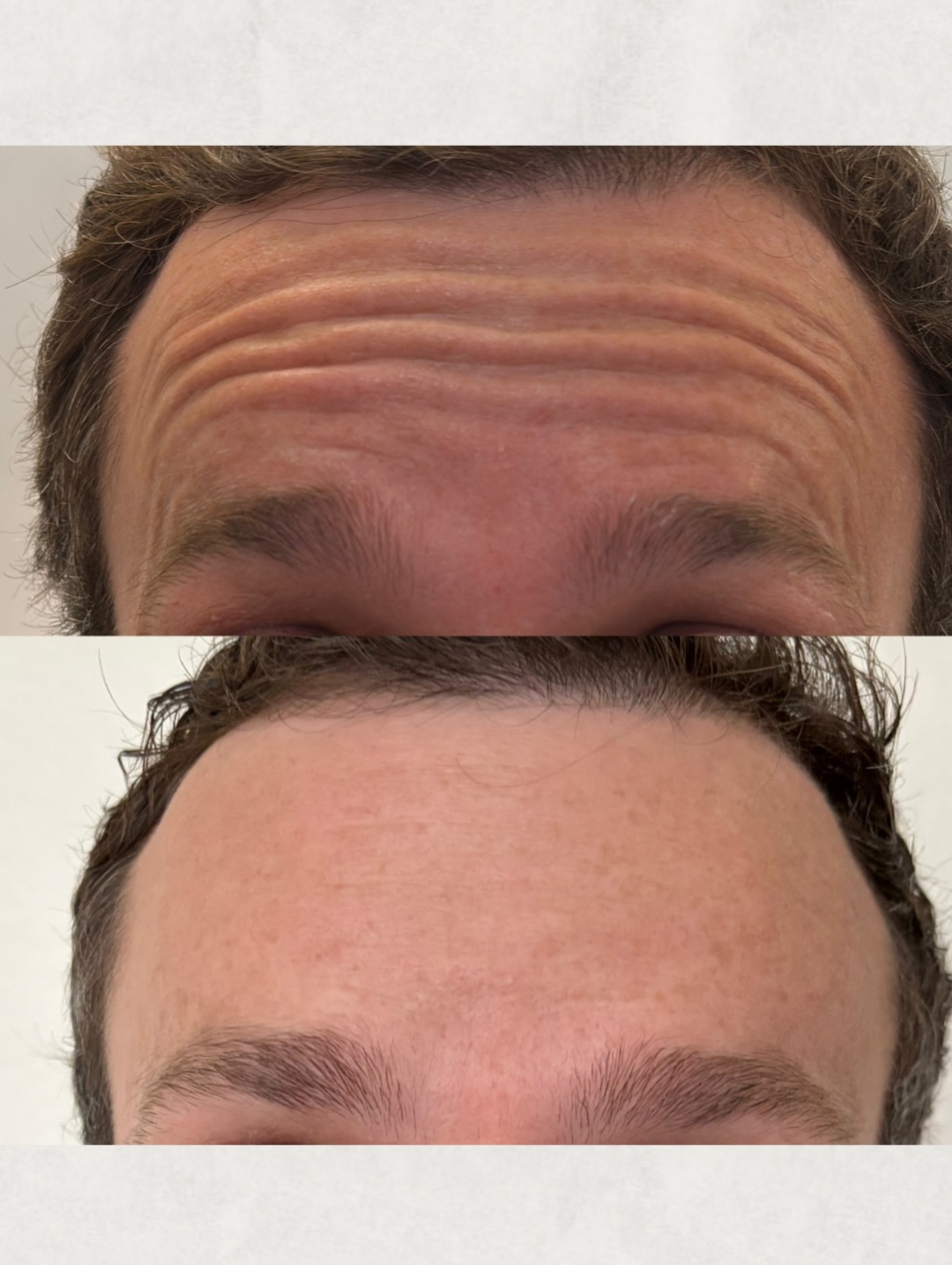 Before and after Brotox forehead treatment showing dramatic reduction of horizontal forehead lines in a male patient