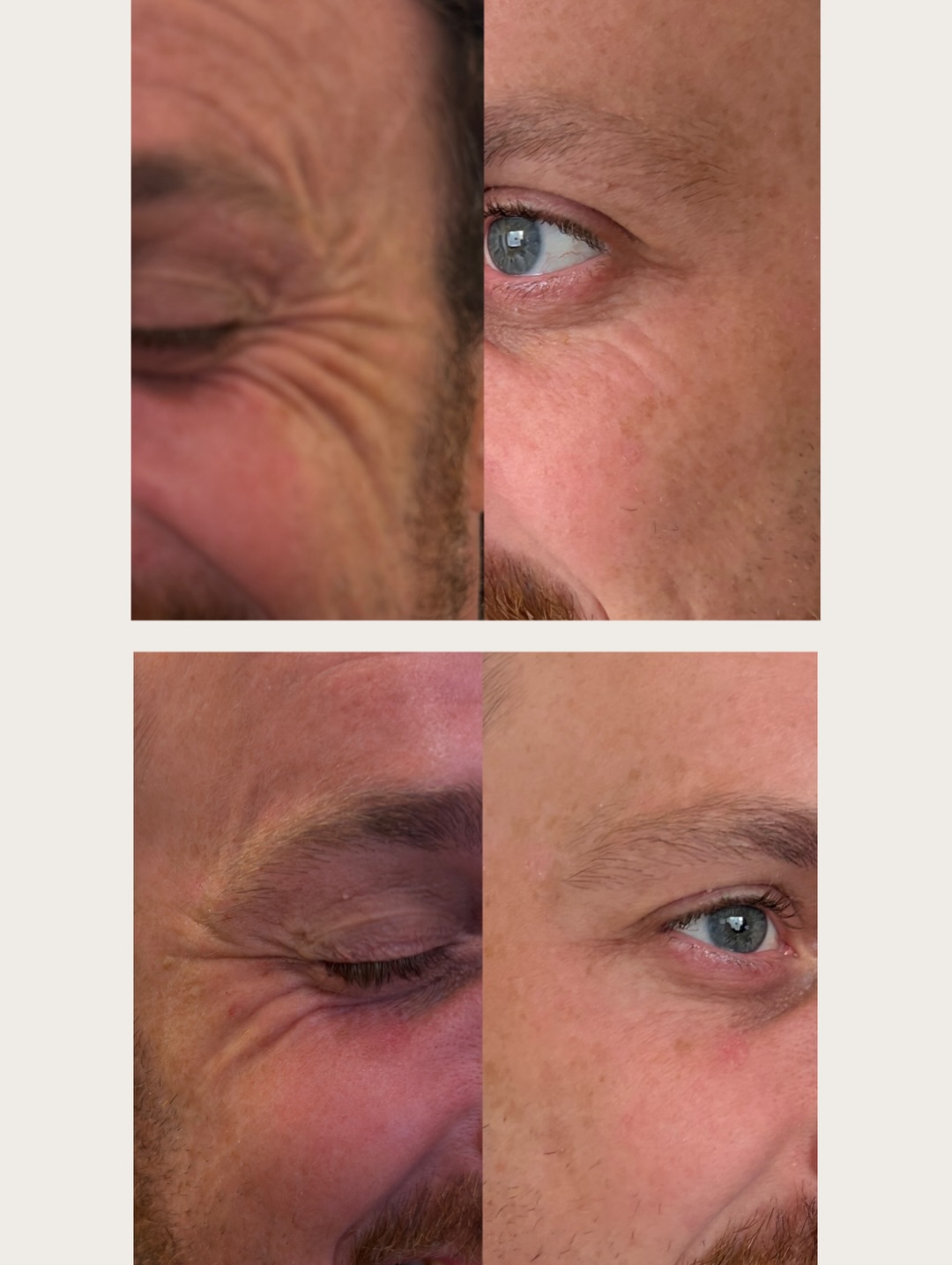 Before and after Brotox crow's feet treatment showing smoothed wrinkles around the eyes in a male patient