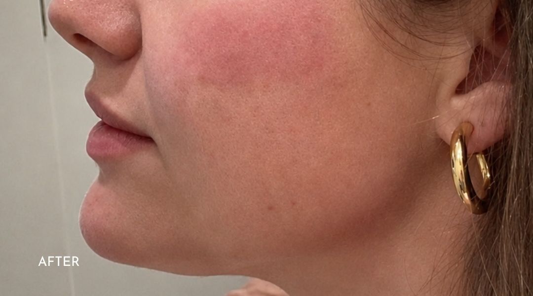 Side profile after Kybella with chin and jawline filler at Call of Beauty in Encinitas, showing a slimmer under-chin and more defined jawline