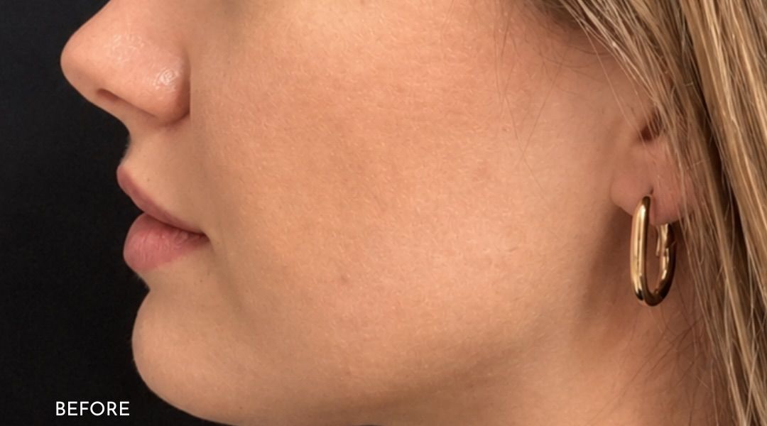 Side profile before Kybella and jawline filler, showing fullness under the chin
