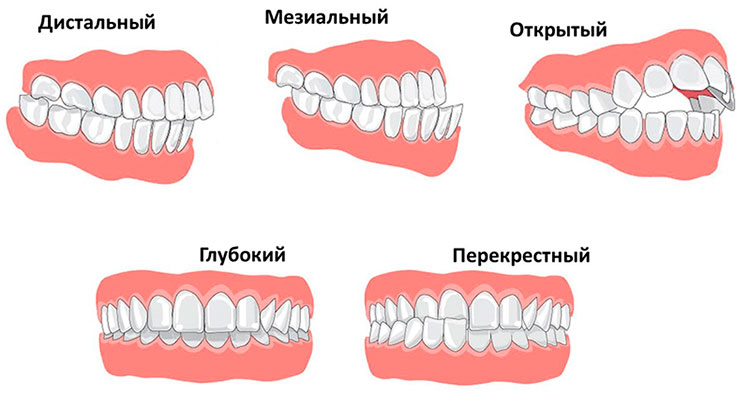 Какой правильный прикус у человека картинки должен