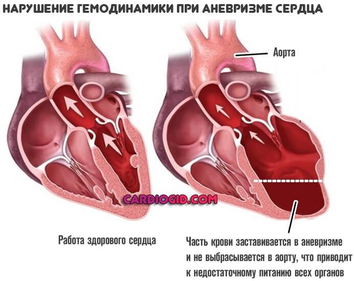 Картине истинной аневризмы в области верхушки миокарда левого желудочка соответствует