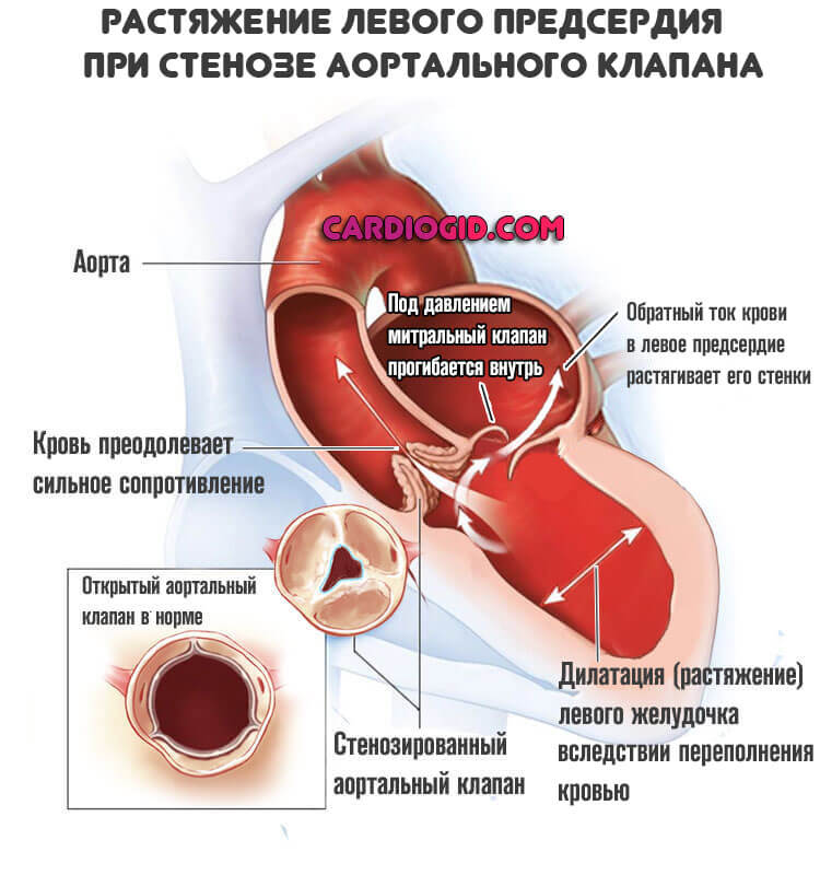 Аортальный клапан картинка