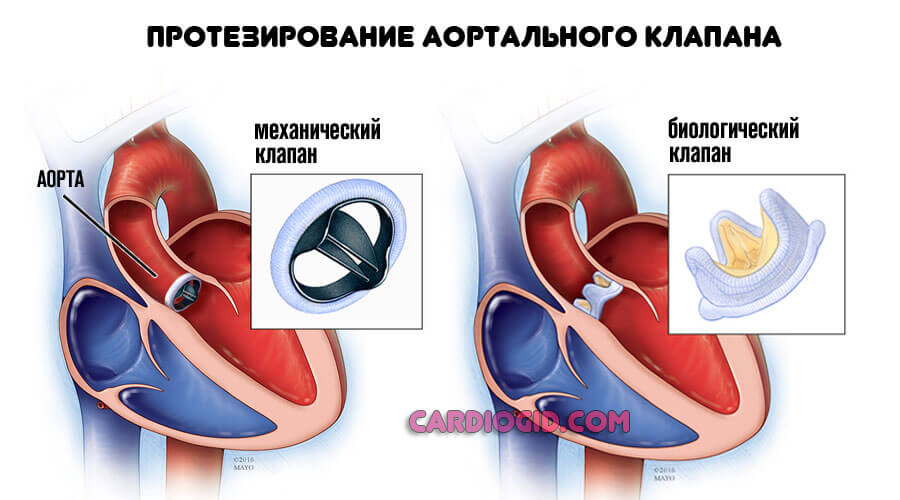 Аортальный клапан картинка