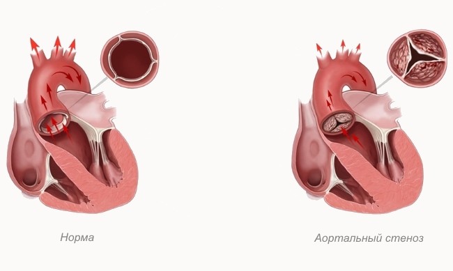 Стеноз аорты у детей презентация