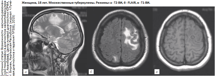 Нервный туберкулез. Туберкулёз центральной нервной системы и мозговых оболочек. Туберкулез мозговых оболочек кт.