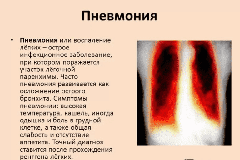 Воспаление легких без температуры признаки у взрослого. Симптомы воспаления легких. Воспаление лёгких симптомы. Симптомы при воспалении легких.