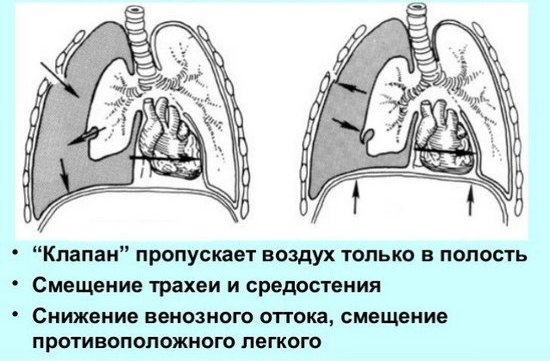 Укажите локализацию двустворчатого клапана