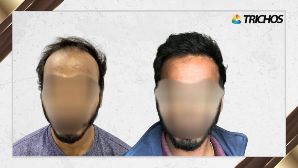 Case #10 — before and after FUE