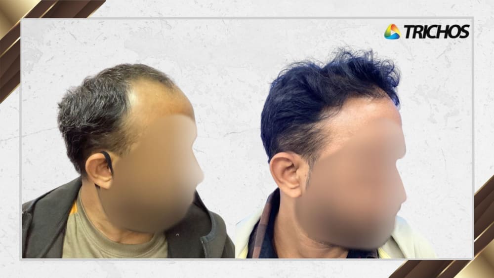 Case #12 — before and after FUE