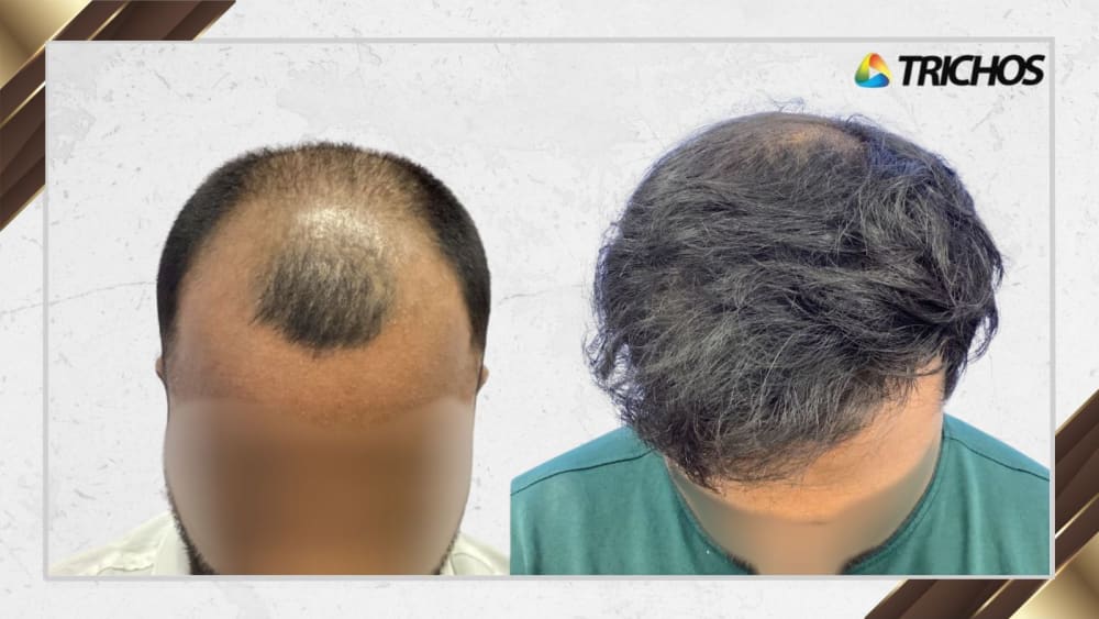 Case #13 — before and after FUE