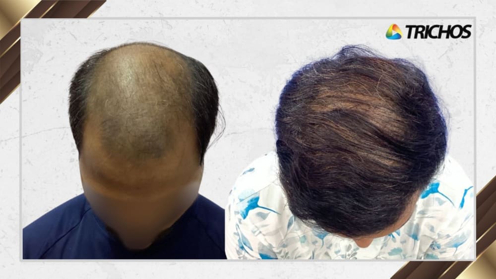 Case #16 — before and after FUE