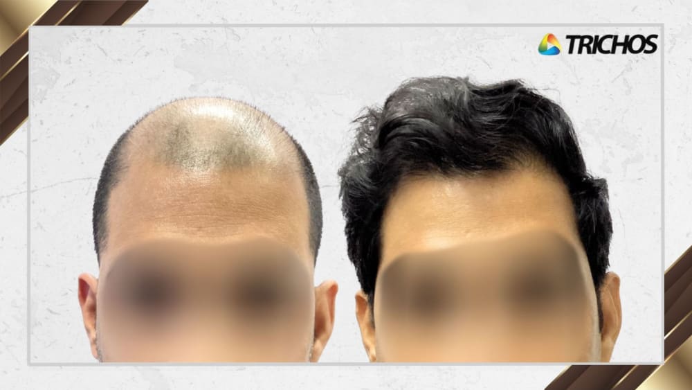 Case #24 — before and after FUE