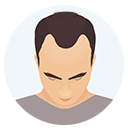 Hair Loss Grade or Level 2