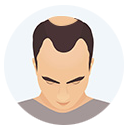 Hair Loss Grade or Level 3