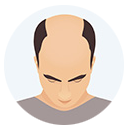 Hair Loss Grade or Level 4