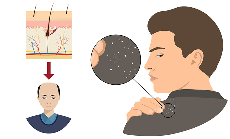 Stop Dandruff Hair Loss With Trichos Care