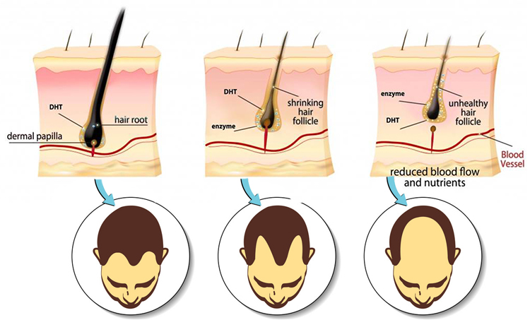 TRICHOS | Hair Fall Prevention With DHT Blocker