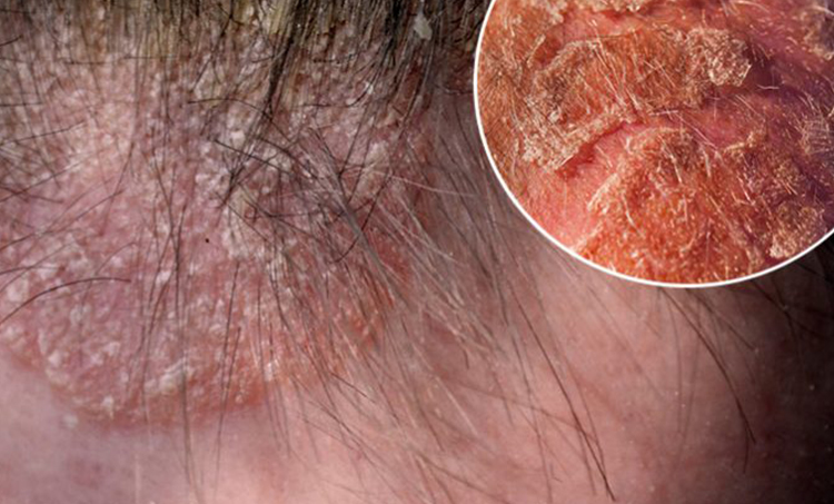 Seborrheic Dermatitis vs Psoriasis Scalp Differences