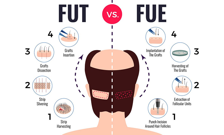 Trichos | Hair Restoration | FUT Hair Transplant Trichos | Hair Restoration | FUT Hair Transplant