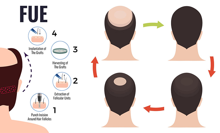 Best Fue Hair Transplant in Hyderabad