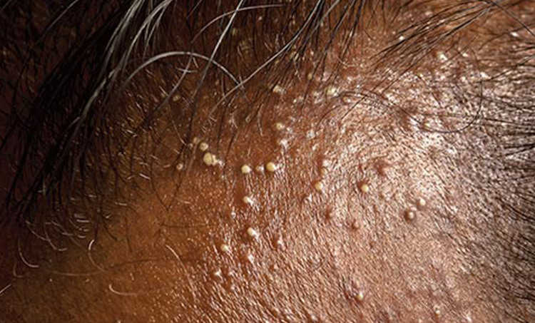 Trichos Hair Loss Solution For Folliculitis Decalvans