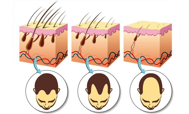 Male pattern baldness Know its causes and treatment