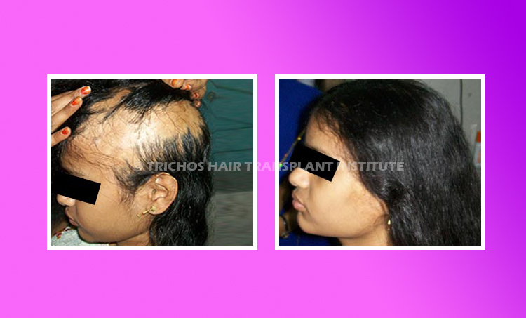 Hair Transplant in Hyderabad  Fascino Body Care