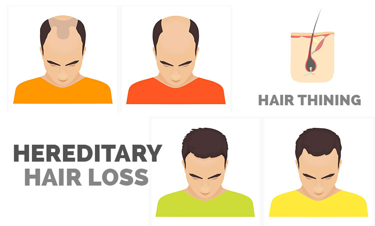 When Hair Loss Is Not Genetic