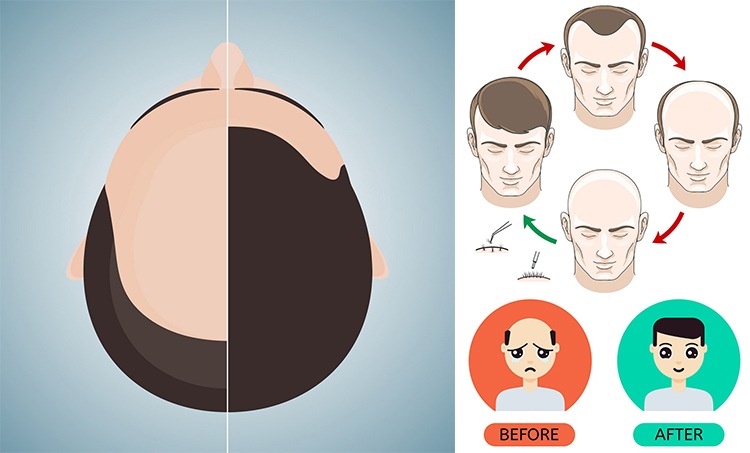 Trichos | Hair Restoration | Hair Transplant in Men Trichos | Hair Restoration | Hair Transplant in Men